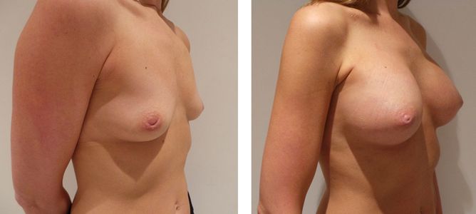35 Year Old Female - Breast Augmentation