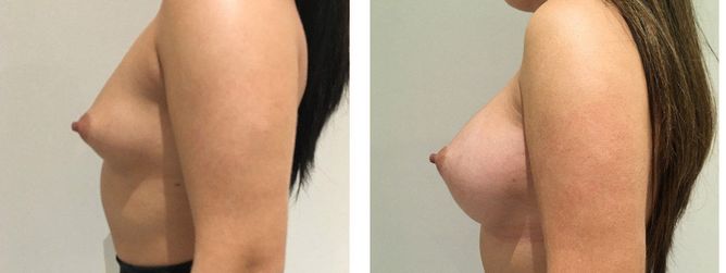 24 Year Old Female - Breast Augmentation