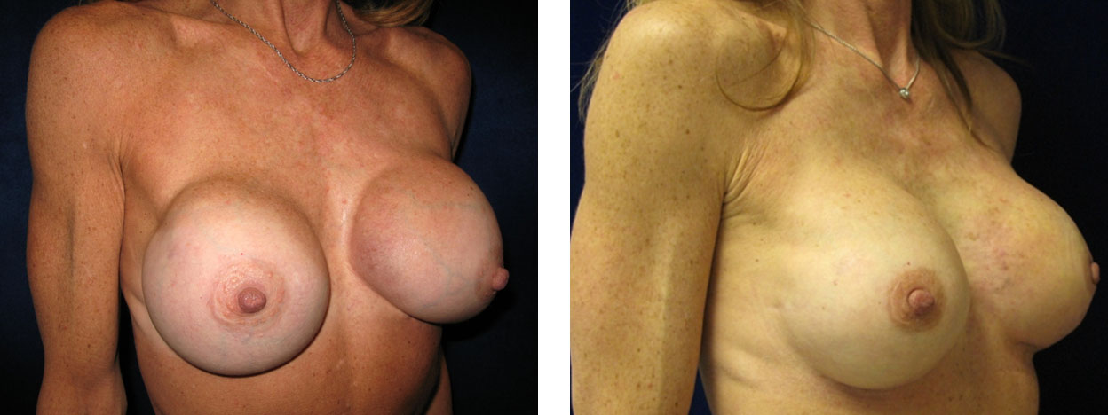 42 Year Old Female - Breast Revision - bodybyZ