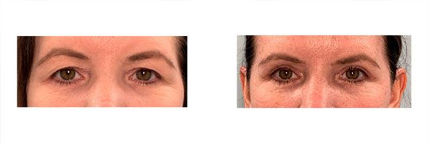 Upper Eyelid Surgery