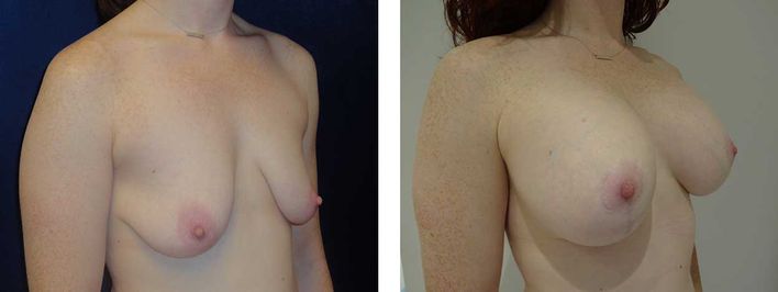 28 Year Old Female - Breast Revision - bodybyZ