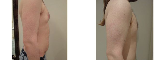 27 Year Old Male - Tummy Tuck Surgery