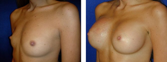 23 Year Old Female - Breast Revision - bodybyZ