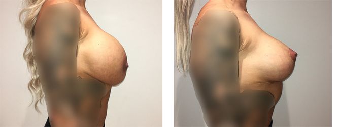 36 Year Old Female - Breast Revision - bodybyZ