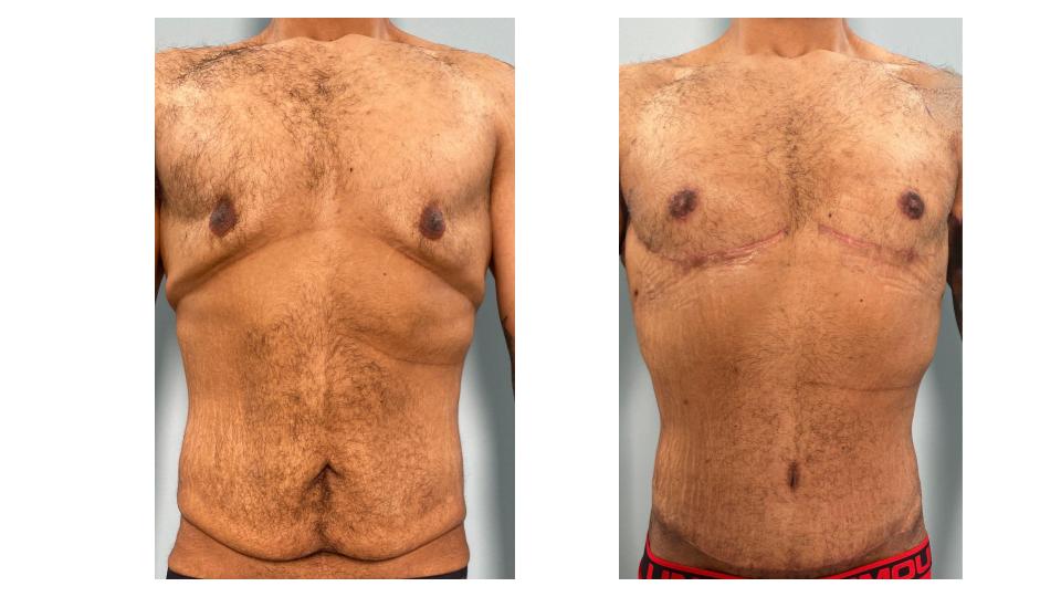 Post-Weight Loss Cosmetic Surgery