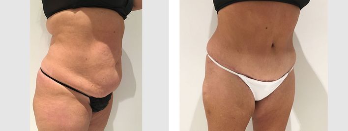 32 Year Old Mother - Tummy Tuck Surgery