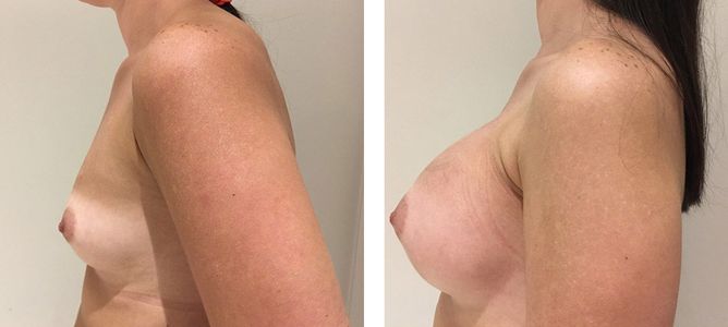 30 Year Old Female - Breast Augmentation