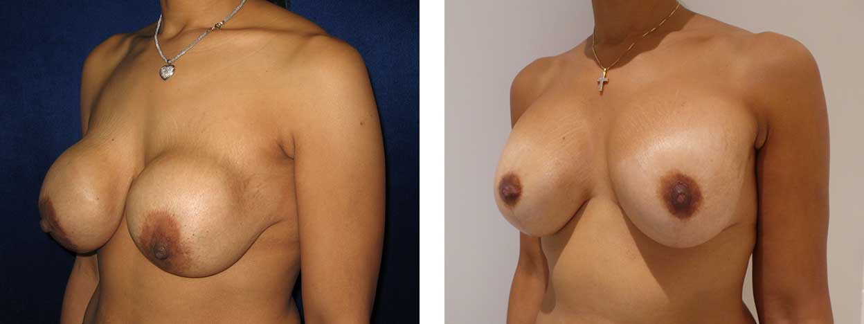 36 Year Old Female - Breast Revision - bodybyZ