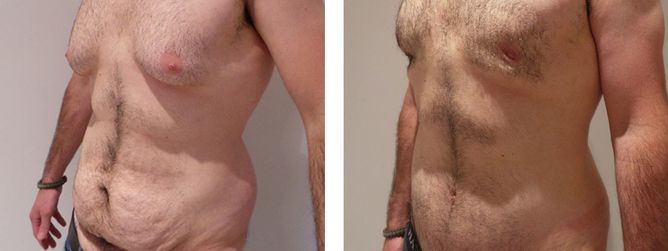 19 Year Old Male - Tummy Tuck Surgery