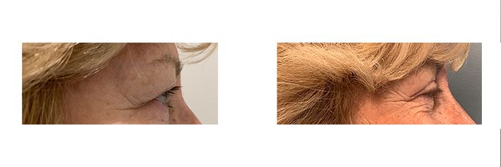 57 Year Old Female - Eyelid Surgery - bodybyZ