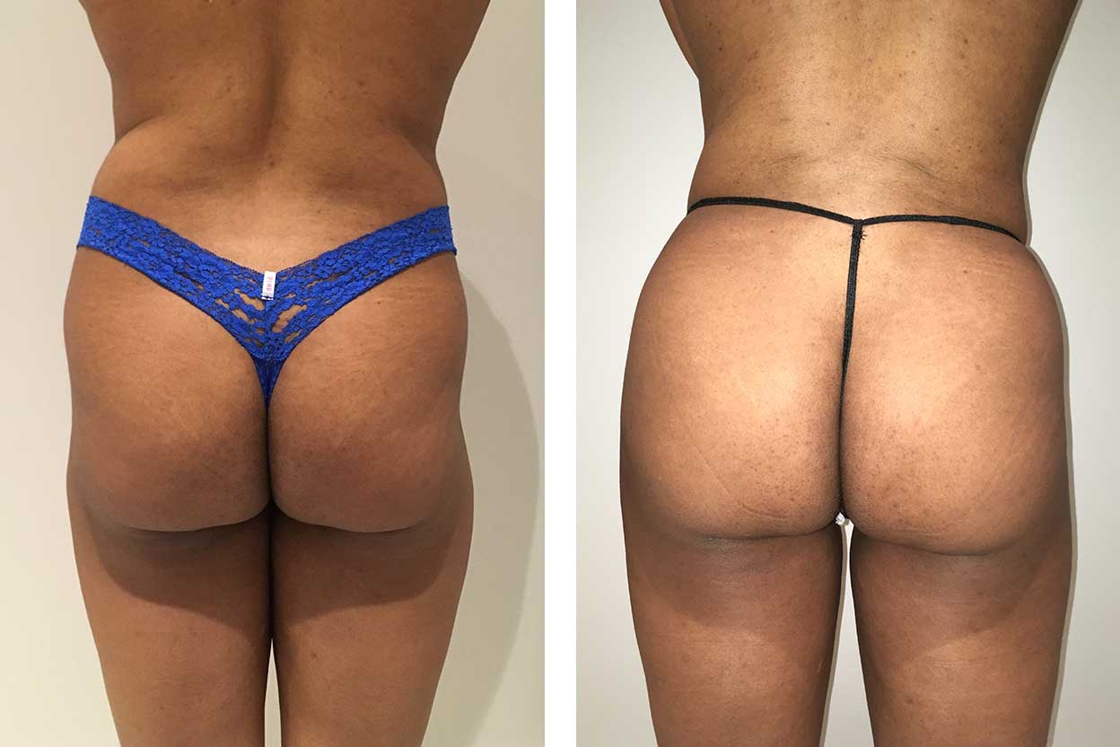 40 Year Old Female - Brazilian Butt Lift - bodybyZ