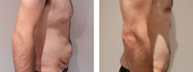 19 Year Old Male - Tummy Tuck Surgery
