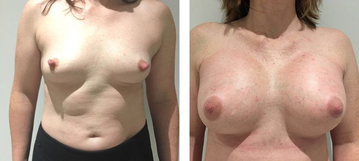 39 Year Old Female - Breast Augmentation