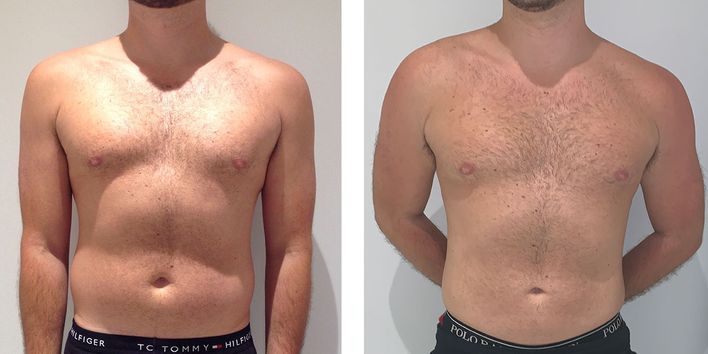 29 Year Old Male - Liposuction - bodybyZ
