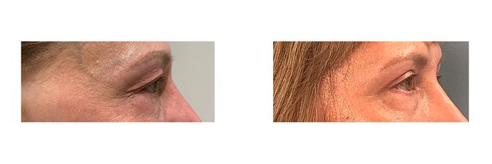 55 Year Old Female - Eyelid Surgery - bodybyZ