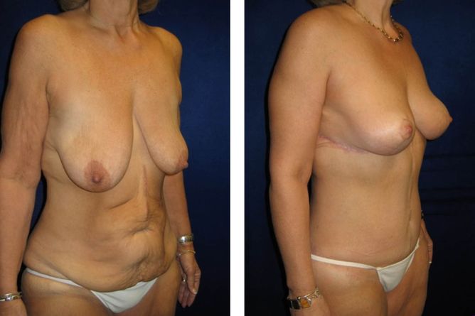 Major Weight Loss Surgery - bodybyZ