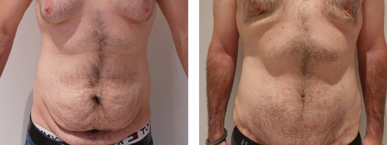 19 Year Old Male - Tummy Tuck Surgery