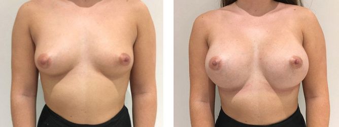24 Year Old Female - Breast Augmentation