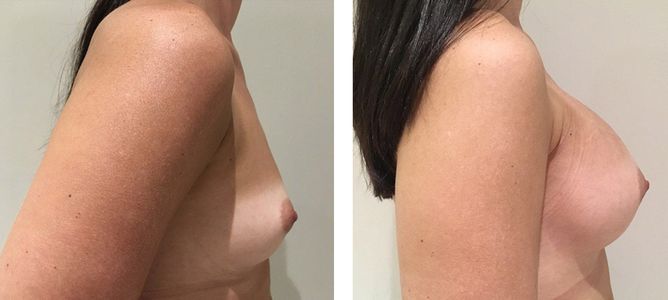 30 Year Old Female - Breast Augmentation