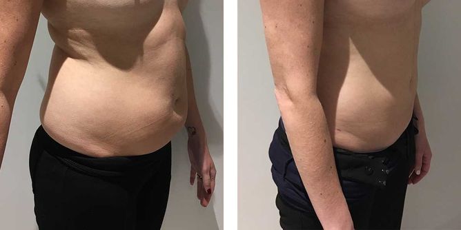 35 Year Old Mother - Liposuction - bodybyZ