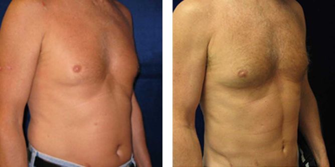 45 Year Old Male - Liposuction - bodybyZ