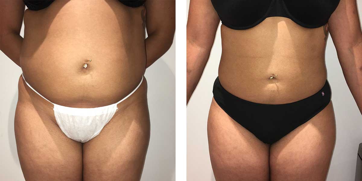 30 Year Old Female - Liposuction - bodybyZ