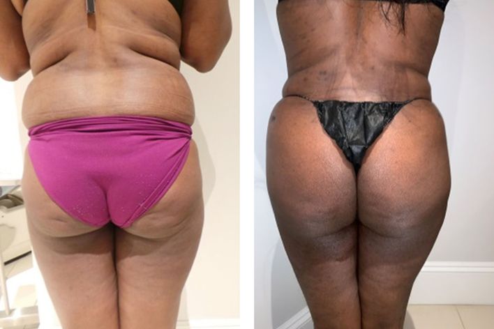 49 Year Old Female - Brazilian Butt Lift - bodybyZ
