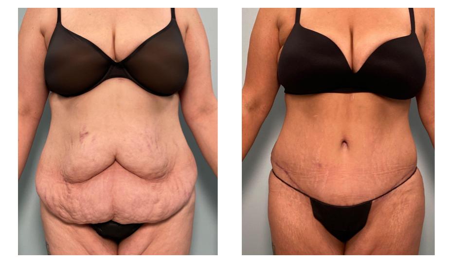 Post-Weight Loss Cosmetic Surgery