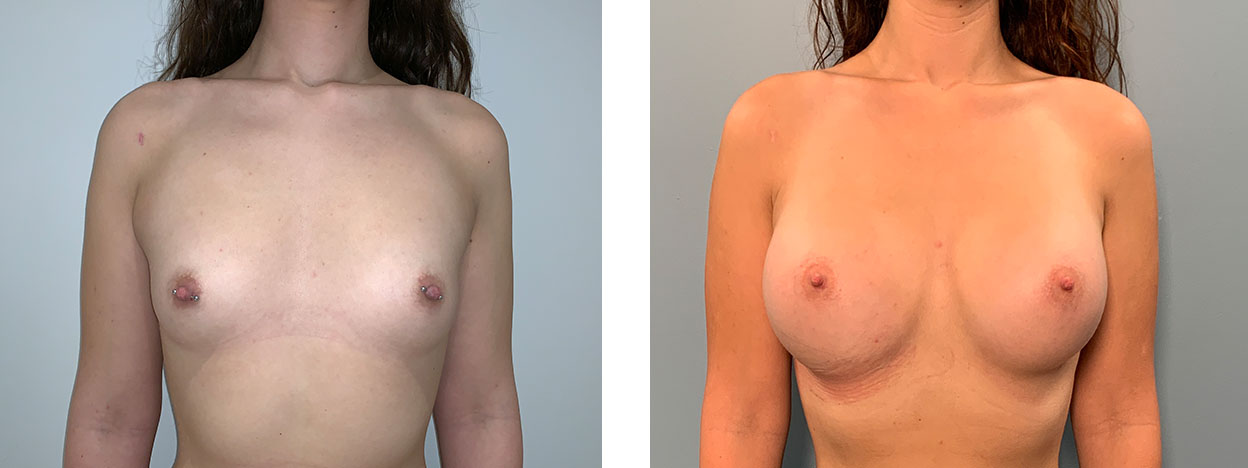 24 Year Old Female - Breast Augmentation