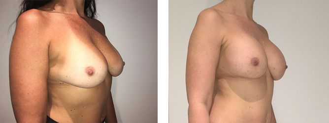 40 Year Old Female - Breast Revision - bodybyZ