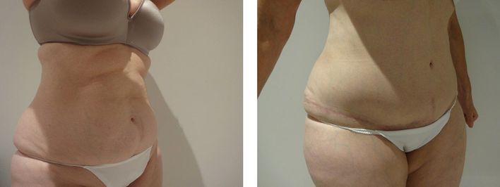 56 Year Old Female - Tummy Tuck Surgery - bodybyZ