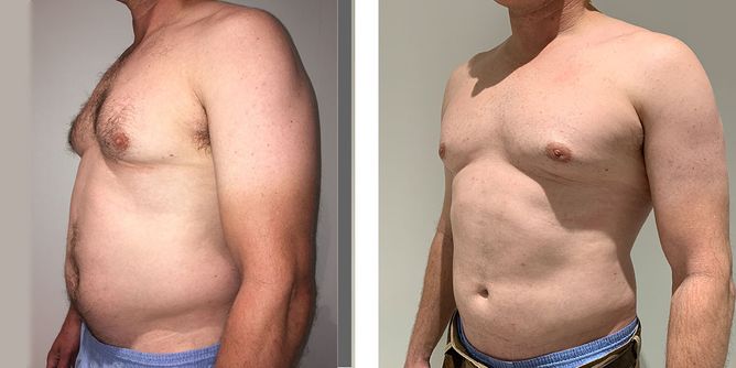 46 Year Old Male - Liposuction - bodybyZ