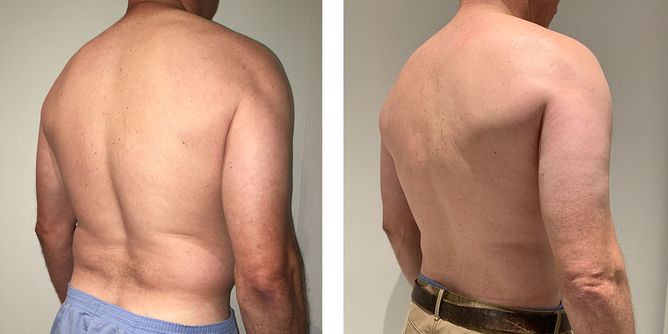 46 Year Old Male - Liposuction - bodybyZ