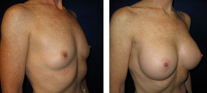 40 Year Old Female - Breast Augmentation