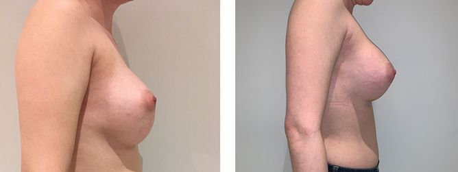 28 Year Old Female - Breast Revision - bodybyZ