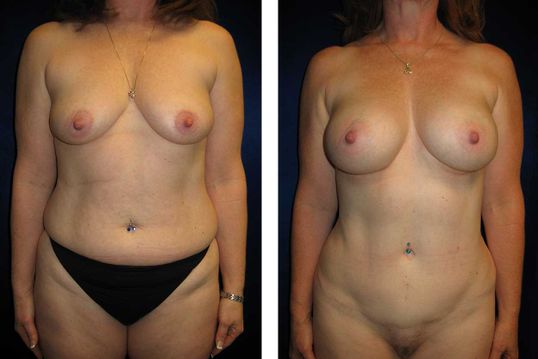 28 Year Old Female - TABA - bodybyZ