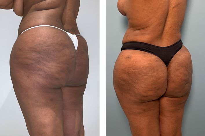 37 Year Old Female - Brazilian Butt Lift - bodybyZ