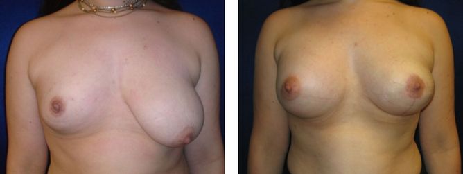 17 Year Old Female - Breast Revision - bodyb