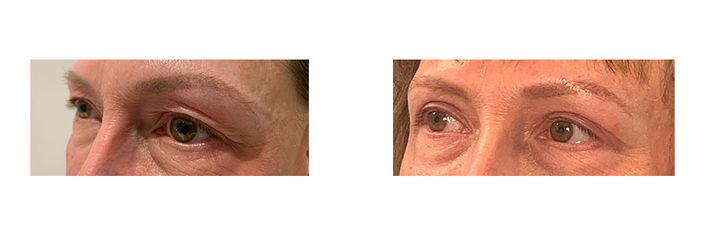 55 Year Old Female - Eyelid Surgery - bodybyZ