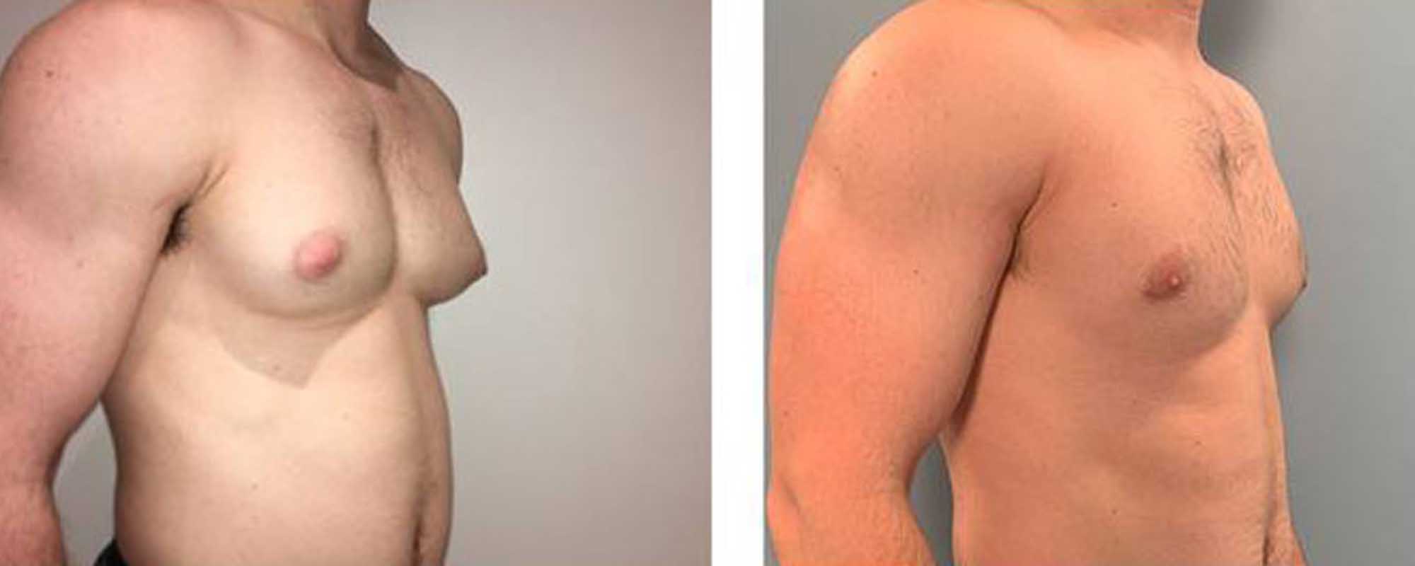 Gynecomastia Surgery