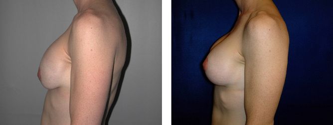 42 Year Old Female - Breast Revision - bodybyZ
