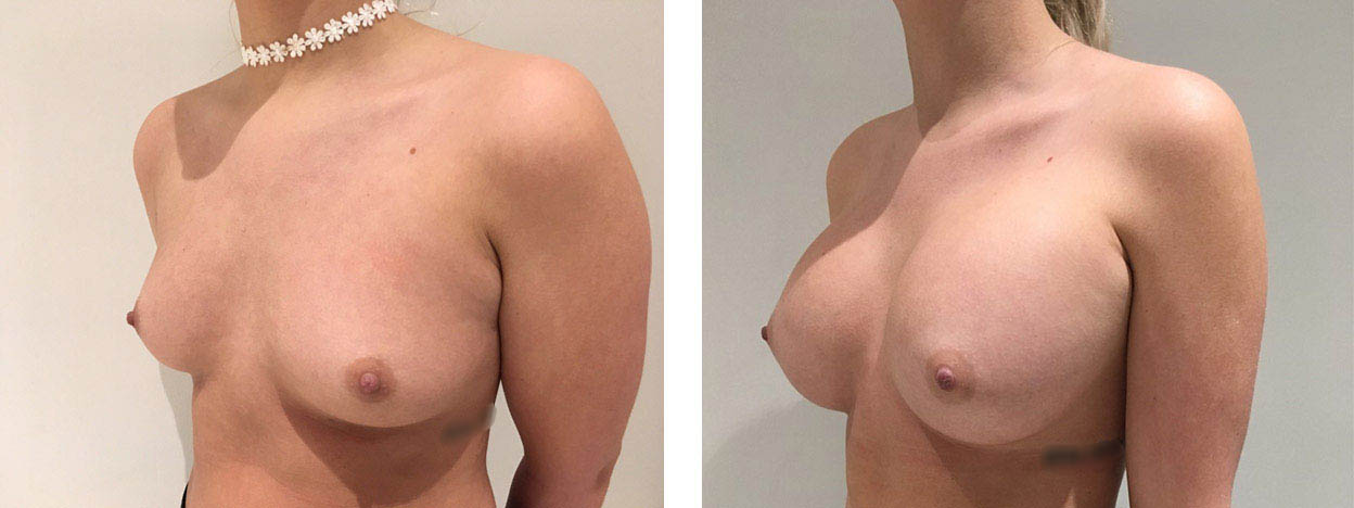 25 Year Old Female - Breast Augmentation