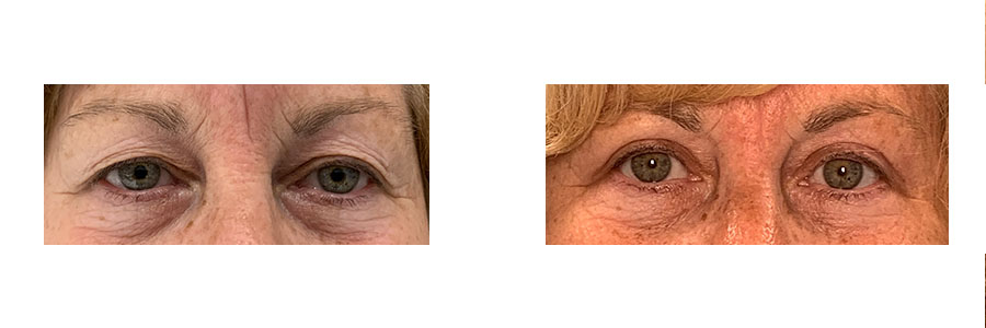 57 Year Old Female - Eyelid Surgery - bodybyZ