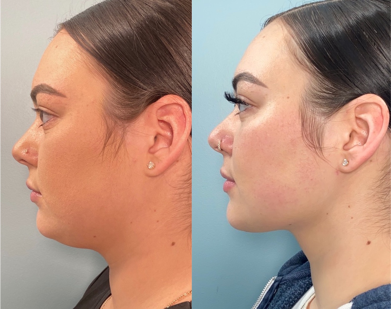 Eyelid Lift Surgery Cranston