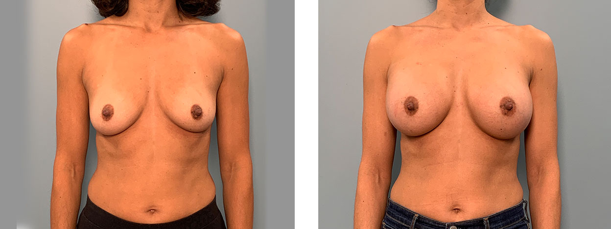Transaxillary Breast Augmentation - 405 CC Natrelle Inspira implants