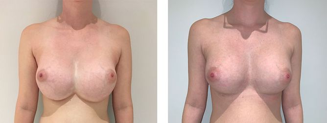28 Year Old Female - Breast Revision - bodybyZ