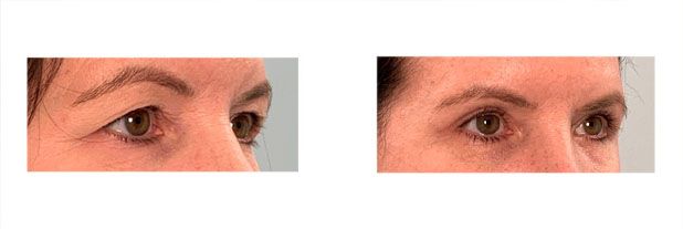 Upper Eyelid Surgery