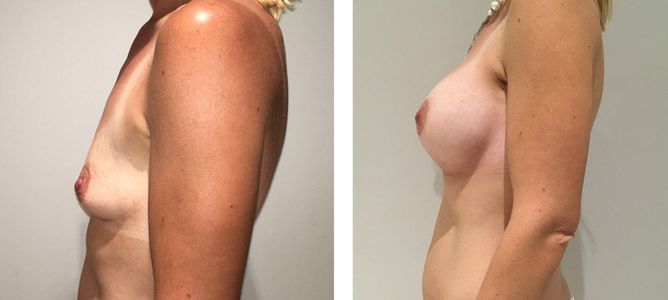 28 Year Old Female - Breast Augmentation