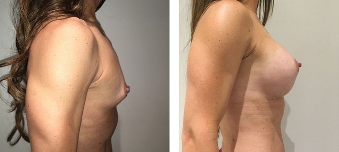 33 Year Old Female - Breast Augmentation