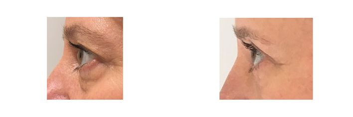 Eyelid Surgery - bodybyZ